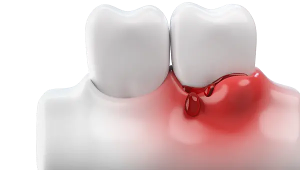 tooth extraction