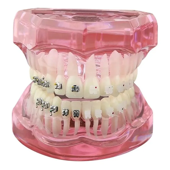 Ceramic Braces