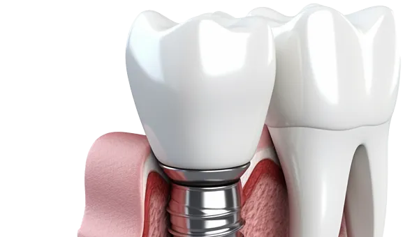 Dental Implant Service In Btm