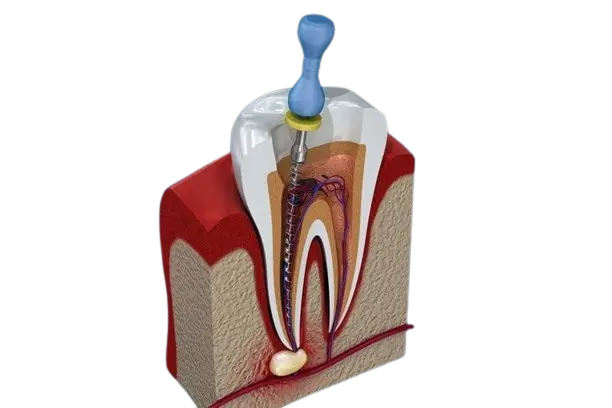 Pulpectomy tooth image